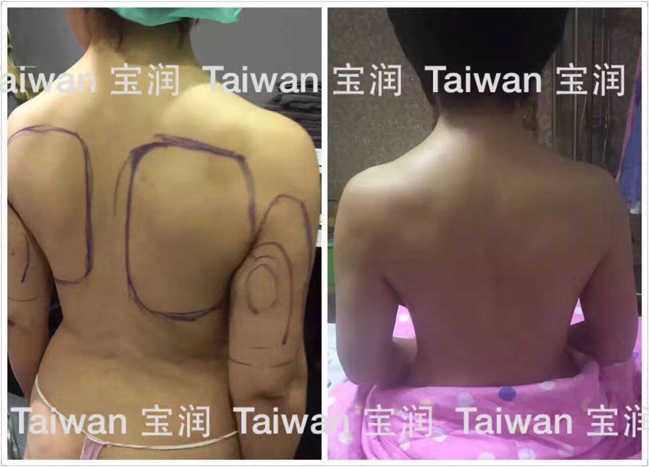 Z波抽脂
